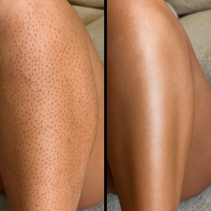 italien: Removely Peel Shot Bundle (+1 bottle for free)